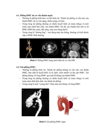 4.1. Phồng ĐMC do xơ vữa thành mạch
- Thường là phồng hình thoi, có khi hình túi. Thành túi phồng có cấu trúc của
thành ĐMC, bị xơ vữa nặng, nhiều mảng vôi hóa.
- Trong lòng túi phồng thường có nhiều huyết khối cũ (màu trắng) và mới
(màu nâu) dính khá chắc vào thành ĐMC, bít tắc các nhánh bên nhỏ ra từ
ĐMC (ĐM liên sườn, đốt sống, mạc treo tràng dưới).
- Trong cùng là “đường ống” - nơi dòng máu lưu thông, thường có kích thước
xấp xỉ ĐMC bình thường.
Hình 4. Phồng ĐMC bụng dưới thận do xơ vữa ĐM
4.2. Giả phồng ĐMC:
- Thường là phồng hình túi. Thành túi phồng không có cấu trúc của thành
ĐMC, bản chất là huyết khối và tổ chức viêm nhiễm và lân cận ĐMC. Túi
phồng thông với lòng ĐMC qua một lỗ thủng của thành ĐMC.
- Trong lòng túi phồng thường có nhiều huyết khối cũ (màu trắng) và mới
(màu nâu) dính khá chắc vào thành túi phồng.
- Trong cùng là một “xoang nhỏ” chứa máu lưu thông với lòng ĐMC.
Hình 5. Giả phồng ĐMC ngực
 