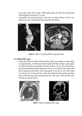 tái tạo được hình ảnh ba chiều. MRI thường được chỉ định cho những bệnh
nhân không thể chụp được CT scans.
- Chụp ĐMC cản quang (kỹ thuật số xóa nền): chỉ định rất hạn chế do là can
thiệp chảy máu và không thấy được tổng thể khối phồng.
Hình 6. MSCT của phồng ĐMC bụng dưới thận.
5.2. Phồng ĐMC ngực
- Hoàn cảnh phát hiện bệnh: hầu hết phồng ĐMC ngực không có triệu chứng
cơ năng đặc hiệu, có thể được phát hiện ngẫu nhiên khi đi chụp x quang ngực
với chẩn đoán khác hoặc khám sức khỏe định kỳ. Số còn lại thường được
phát hiện khi phồng đã biến chứng dọa vỡ hay vỡ với dấu hiệu đau ngực. Đôi
khi túi phồng quá lớn hoặc viêm xung quanh có thể gây ra các triệu chứng
của chèn ép các cơ quan lân cận, như: chèn thần kinh quặt ngược gây khàn
tiếng, chèn khí quản, thực quản gây khó thở, nuốt ngẹn, chèn ép tĩnh mạch
chủ trên gây phù áo khoác.
Hình 7. MRI của phồng ĐMC ngực.
 