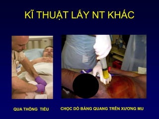 KĨ THUẬT LẤY NT KHÁC
QUA THÔNG TIỂU CHỌC DÒ BÀNG QUANG TRÊN XƯƠNG MU
 