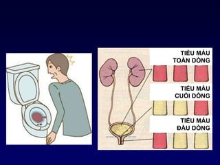 TIỂU MÁU
TOÀN DÒNG
TIỂU MÁU
CUỐI DÒNG
TIỂU MÁU
ĐẦU DÒNG
 