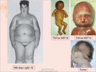Thể ba NST13Thể ba NST18
Turner
Mất đoạn ngắn 15 Nguyễn Xuân Khoa -
xuankhoa.nguyen@gmail.com
 