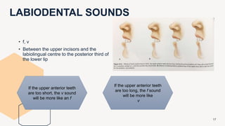 LABIODENTAL SOUNDS
17
• f, v
• Between the upper incisors and the
labiolingual centre to the posterior third of
the lower lip
If the upper anterior teeth
are too short, the v sound
will be more like an f
If the upper anterior teeth
are too long, the f sound
will be more like
v
 