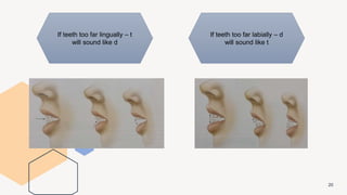 20
If teeth too far lingually – t
will sound like d
If teeth too far labially – d
will sound like t
 