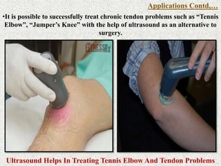 Ultrasound Helps In Treating Tennis Elbow And Tendon Problems
•It is possible to successfully treat chronic tendon problems such as “Tennis
Elbow”, “Jumper’s Knee” with the help of ultrasound as an alternative to
surgery.
Applications Contd,…
 