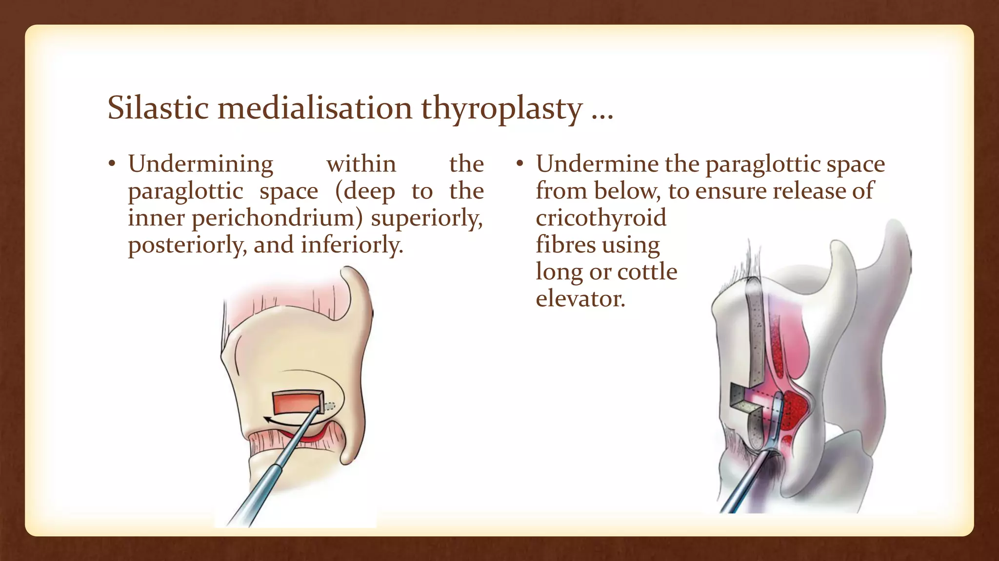 Phonosurgery Pdf 