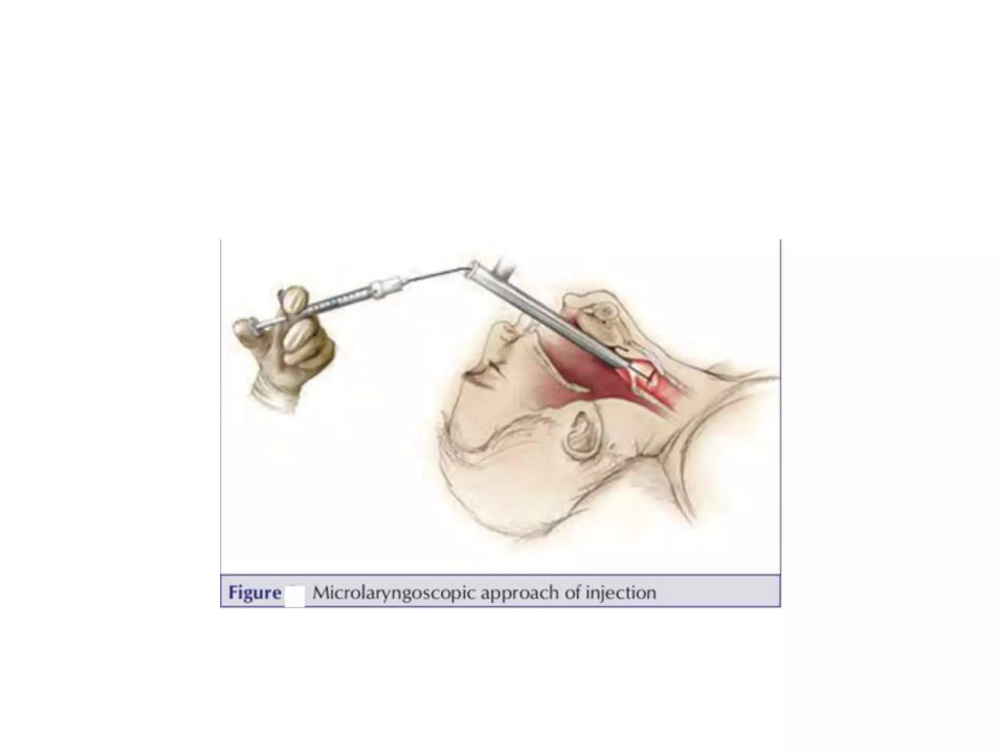 Postauricular Injection Phonosurgery | PPTX