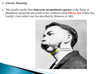  Chronic Poisoning:
a. This usually results from long-term occupational exposure to the fumes of
phosphorus pentoxide and results in the condition called Phossy Jaw (Glass Jaw,
Lucifer’s Jaw) which was first described by Bristowe in 1862.
Fistula draining
foul-smelling pus
 