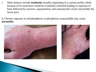 i. Main features include toothache (usually originating in a carious tooth), which
because of its recurrence would be eventually extracted leading to exposure of
bone followed by necrosis, sequestration, and osteomyelitis of jaw (invariably the
lower jaw).
b. Chronic exposure to red phosphorus or phosphorus sesquisulfide may cause
dermatitis.
 