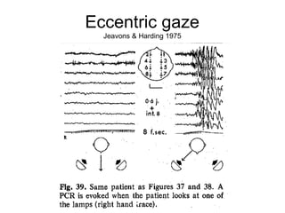 Eccentric gaze
Jeavons & Harding 1975
 