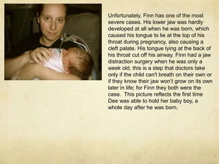 Unfortunately, Finn has one of the most severe cases. His lower jaw was hardly developed at all when he was born, which caused his tongue to lie at the top of his throat during pregnancy, also causing a cleft palate. His tongue lying at the back of his throat cut off his airway. Finn had a jaw distraction surgery when he was only a week old, this is a step that doctors take only if the child can't breath on their own or if they know their jaw won’t grow on its own later in life; for Finn they both were the case.  This picture reflects the first time Dee was able to hold her baby boy, a whole day after he was born.