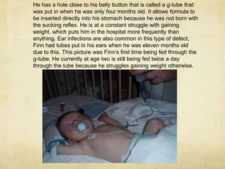 He has a hole close to his belly button that is called a g-tube that was put in when he was only four months old. It allows formula to be inserted directly into his stomach because he was not born with the sucking reflex. He is at a constant struggle with gaining weight, which puts him in the hospital more frequently than anything. Ear infections are also common in this type of defect, Finn had tubes put in his ears when he was eleven months old due to this. This picture was Finn’s first time being fed through the g-tube. He currently at age two is still being fed twice a day through the tube because he struggles gaining weight otherwise.