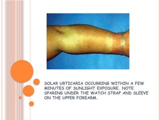 Solar Photodermatosis Photobiology and photosensitive dermatoses | PPTX