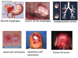 Barrett esophagus Cancer of the esophagus  endobronchial  cancer. basal cell carcinoma   squamous cell  carcinoma Tumor of cervix 
