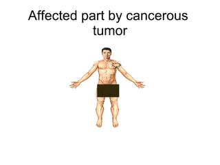 Affected part by cancerous  tumor 