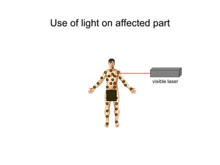 Use of light on affected part visible laser 