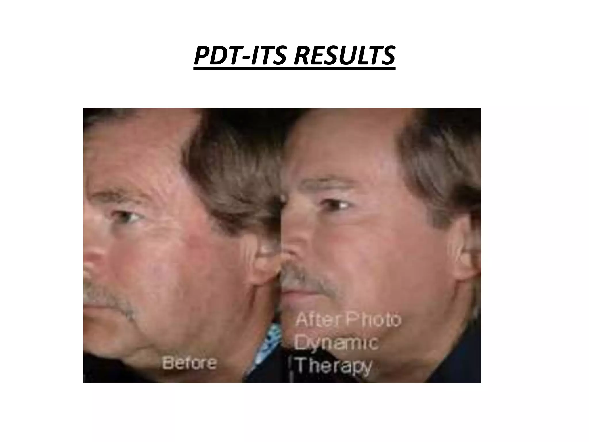 Photo dynamic therapy | PPTX