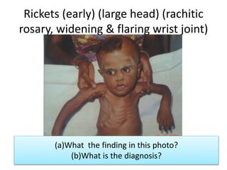 Head In Rickets Photo for child osce final version whh 1 (1) | PPTX