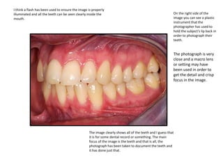 On the right side of the
image you can see a plastic
instrument that the
photographer has used to
hold the subject’s lip back in
order to photograph their
teeth.
The photograph is very
close and a macro lens
or setting may have
been used in order to
get the detail and crisp
focus in the image.
The image clearly shows all of the teeth and I guess that
it is for some dental record or something. The main
focus of the image is the teeth and that is all, the
photograph has been taken to document the teeth and
it has done just that.
I think a flash has been used to ensure the image is properly
illuminated and all the teeth can be seen clearly inside the
mouth.
 