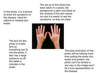 In this photo, it is a picture
to show the symptoms of
the disease. Used for
referral or medical text
books.
The set up of this photo has
been taken in a studio, the
background is plain and black so
the contrast of the skin stands
out and it is easier to see the
symptoms, so they are clear.
The lens for this
photo is a wide
lens so
everything can fit
into the photo. It
also has a large
exposure so all
the detail is
included in the
photo.
The post production of this
photo will be nothing more
than putting the photo into
books and posters, the
photo can’t be tainted in
any way or the image won’t
be a true representation of
the disease.
 
