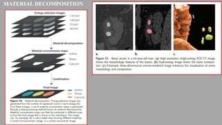 Computed Tomography Photon counting detector | PPTX
