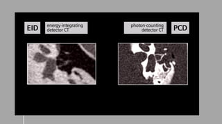 Computed Tomography Photon counting detector | PPTX