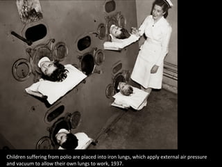 Children suffering from polio are placed into iron lungs, which apply external air pressure
and vacuum to allow their own lungs to work, 1937.
 