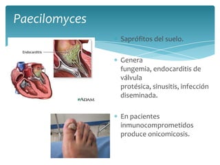PaecilomycesSaprófitos del suelo.Genera fungemia, endocarditis de válvula protésica, sinusitis, infección diseminada.En pacientes inmunocomprometidos produce onicomicosis.
