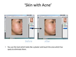 ‘Skin with Acne’
• You use the tool which looks like a plaster and touch the area which has
spots to eliminate them.
 