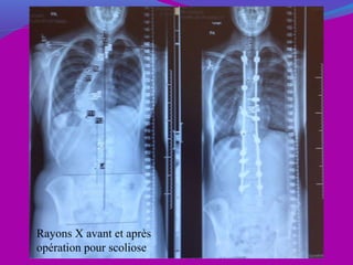 Rayons X avant et après
opération pour scoliose
 