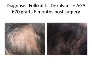 Diagnosis: Follikülitis Dekalvans + AGA
670 grafts 6 months post surgery
 