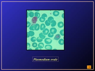 Plasmodium ovale
 