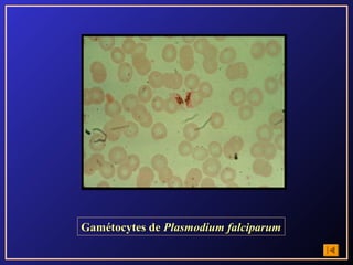 Gamétocytes de Plasmodium falciparum
 