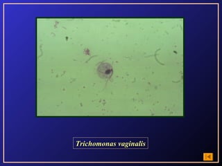 Trichomonas vaginalis
 