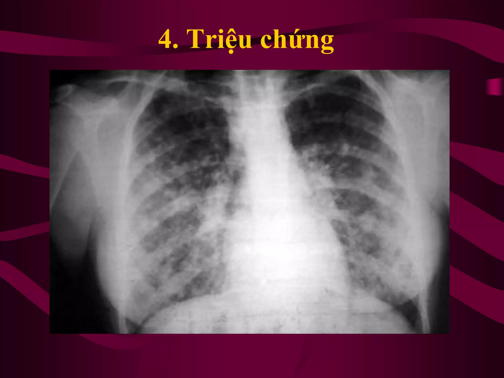 4. Triệu chứng
 