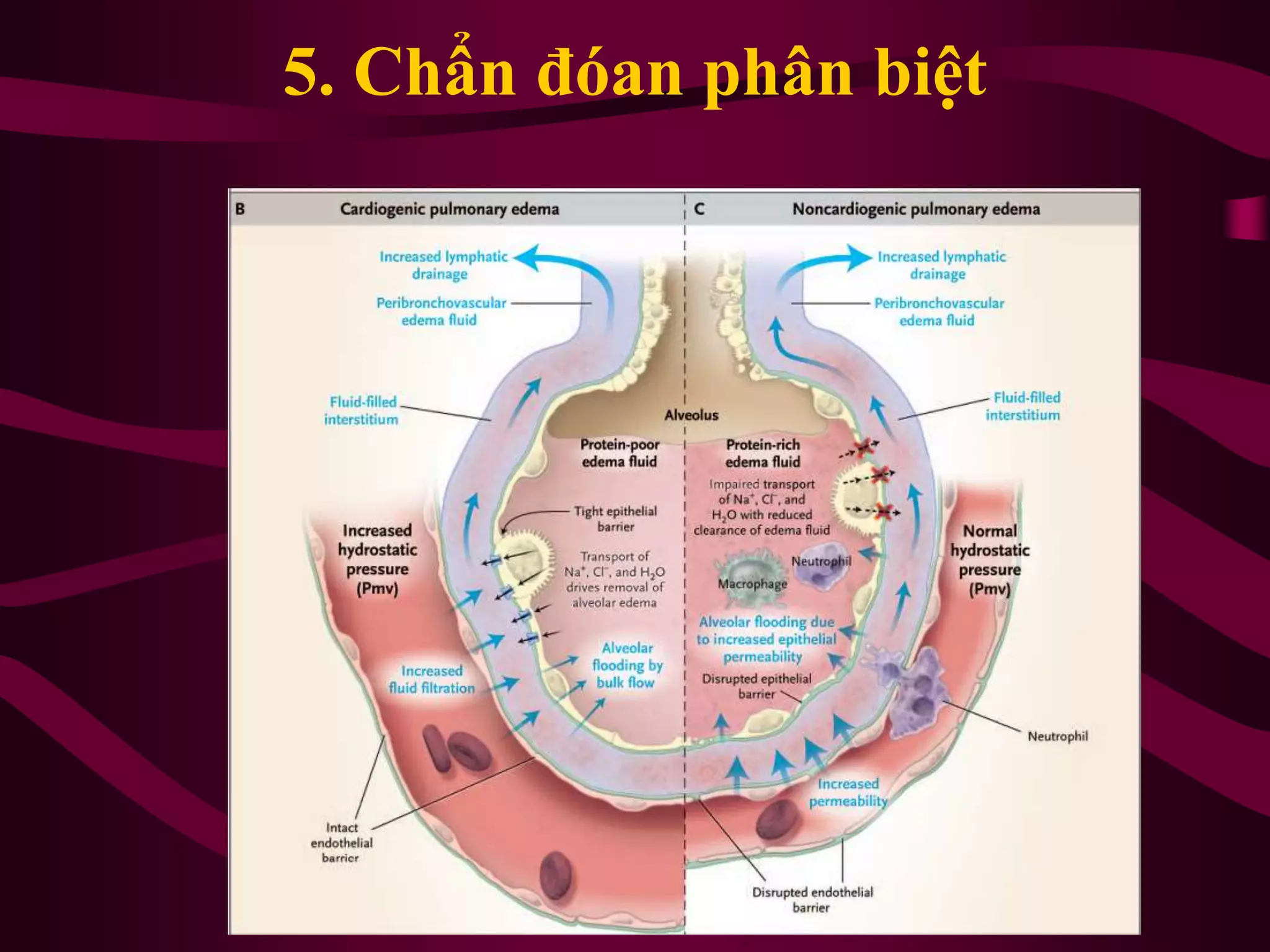 5. Chẩn đóan phân biệt
 