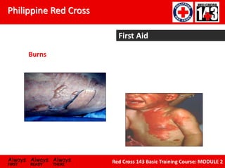 Philippine Red Cross
Always Always Always
FIRST READY THERE
Red Cross 143 Basic Training Course: MODULE 2
First Aid
Burns
 