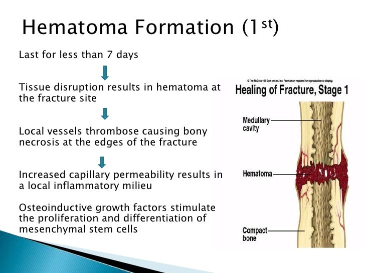 Phsiology of fractures