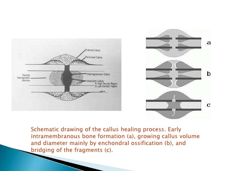 Phsiology of fractures