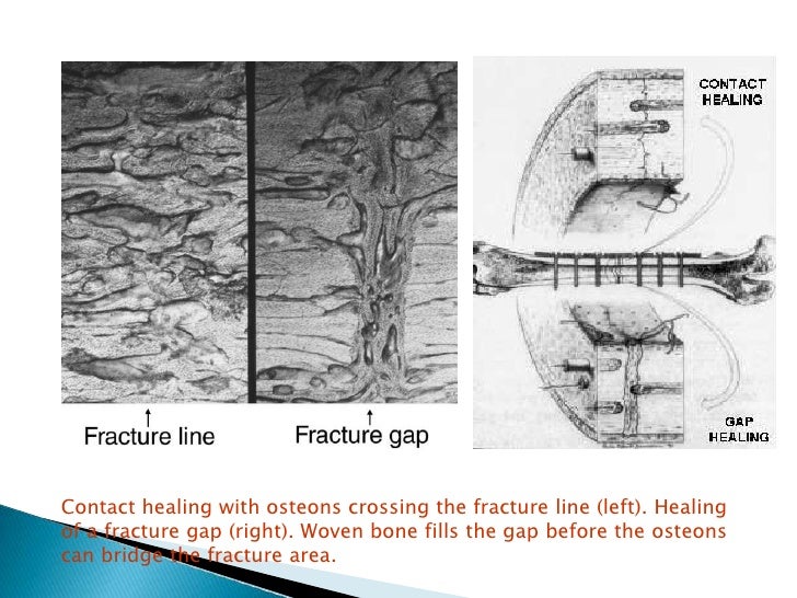 Phsiology of fractures