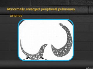 Abnormally enlarged peripheral pulmonary
arteries
 