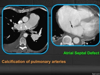 Calcification of pulmonary arteries
Atrial Septal Defect
 