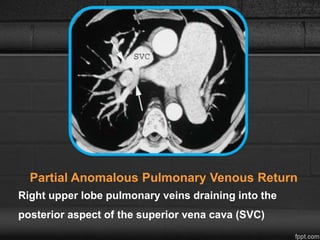 Partial Anomalous Pulmonary Venous Return
Right upper lobe pulmonary veins draining into the
posterior aspect of the superior vena cava (SVC)
 