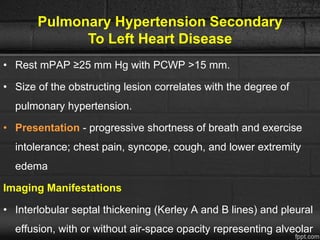 Pulmonary Hypertension Secondary
To Left Heart Disease
• Rest mPAP ≥25 mm Hg with PCWP >15 mm.
• Size of the obstructing lesion correlates with the degree of
pulmonary hypertension.
• Presentation - progressive shortness of breath and exercise
intolerance; chest pain, syncope, cough, and lower extremity
edema
Imaging Manifestations
• Interlobular septal thickening (Kerley A and B lines) and pleural
effusion, with or without air-space opacity representing alveolar
 