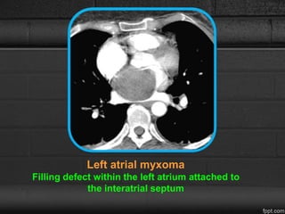 Left atrial myxoma
Filling defect within the left atrium attached to
the interatrial septum
 
