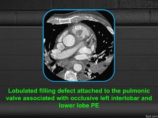 Lobulated filling defect attached to the pulmonic
valve associated with occlusive left interlobar and
lower lobe PE
 
