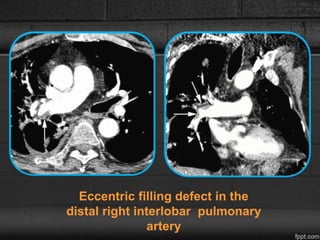 Eccentric filling defect in the
distal right interlobar pulmonary
artery
 