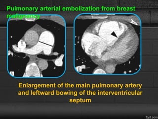 Pulmonary arterial embolization from breast
malignancy
Enlargement of the main pulmonary artery
and leftward bowing of the interventricular
septum
 