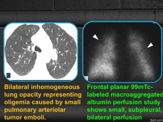 Bilateral inhomogeneous
lung opacity representing
oligemia caused by small
pulmonary arteriolar
tumor emboli.
Frontal planar 99mTc-
labeled macroaggregated
albumin perfusion study
shows small, subpleural,
bilateral perfusion
 