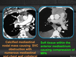 Calcified mediastinal
nodal mass causing SVC
obstruction with
numerous mediastinal
Soft tissue within the
anterior mediastinum
causing compression of
MPA
 