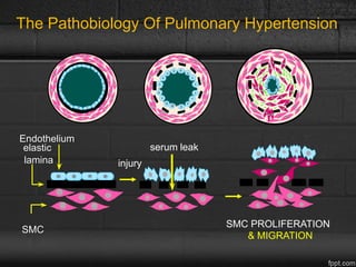 SMC
Endothelium
elastic
lamina injury
serum leak
SMC PROLIFERATION
& MIGRATION
The Pathobiology Of Pulmonary Hypertension
 